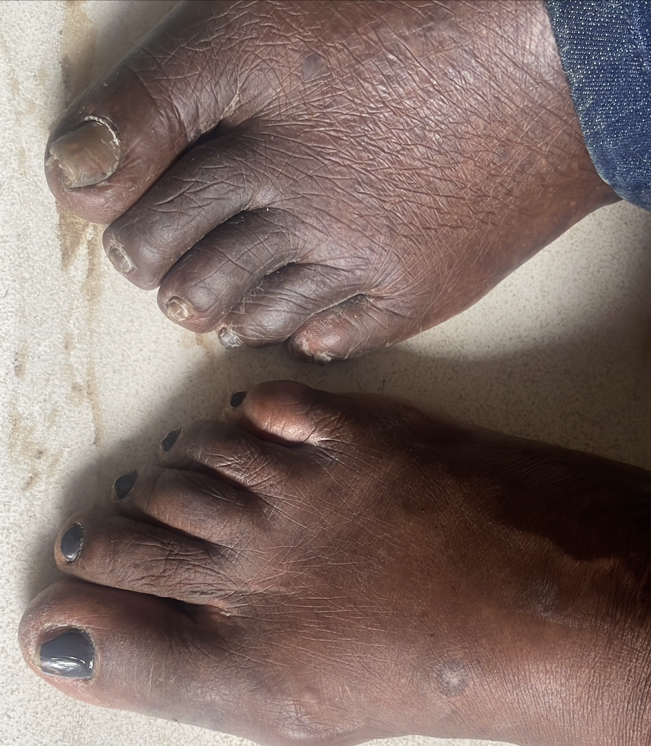 CHANGE IN COLOR OF TOES COULD BE SERIOUS!