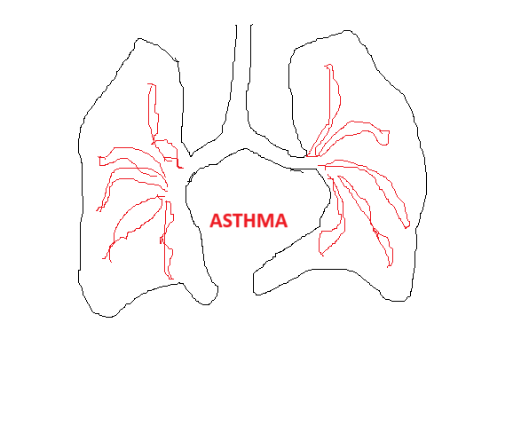 INTRACTABLE ASTHMA IN 72 YEAR LADY